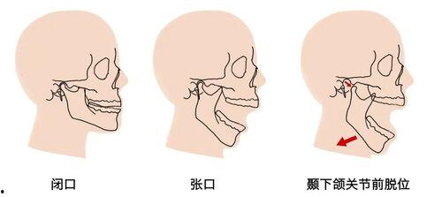 吃瓜下巴脱臼视频,一场意外引发的围观热潮